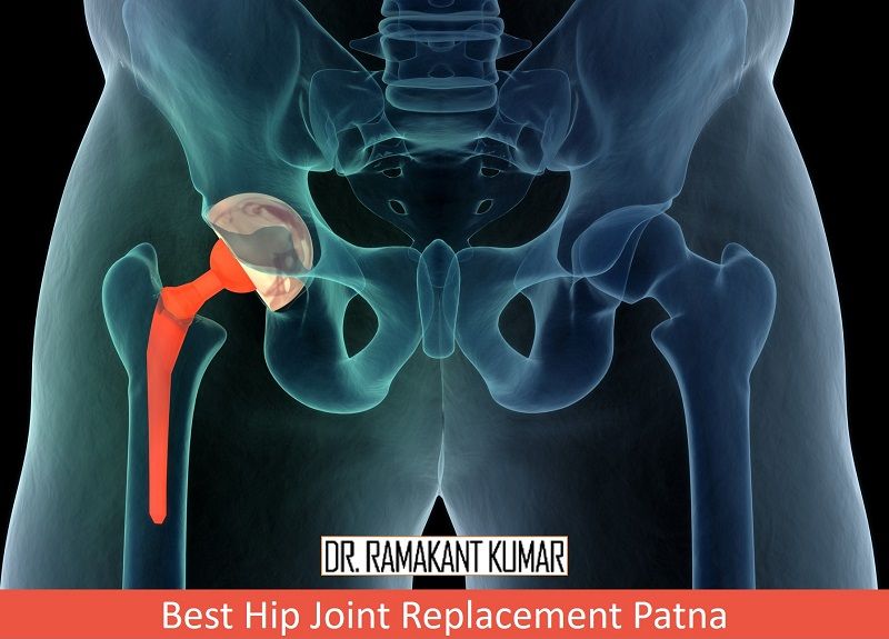 hip joint replacement patna