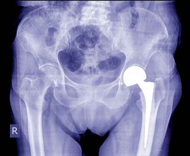 hip replacement surgery pictures