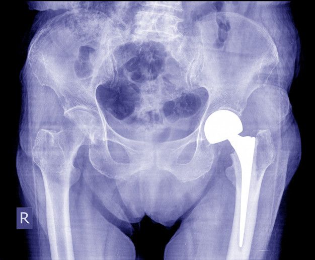 Total Hip Replacement Surgery  Orthopedic Doctor in Patna Bihar