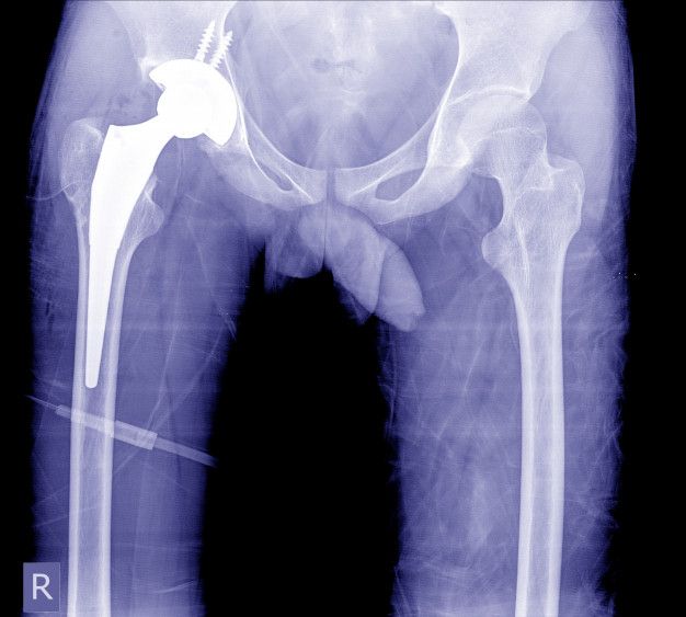 hip replacement symptoms