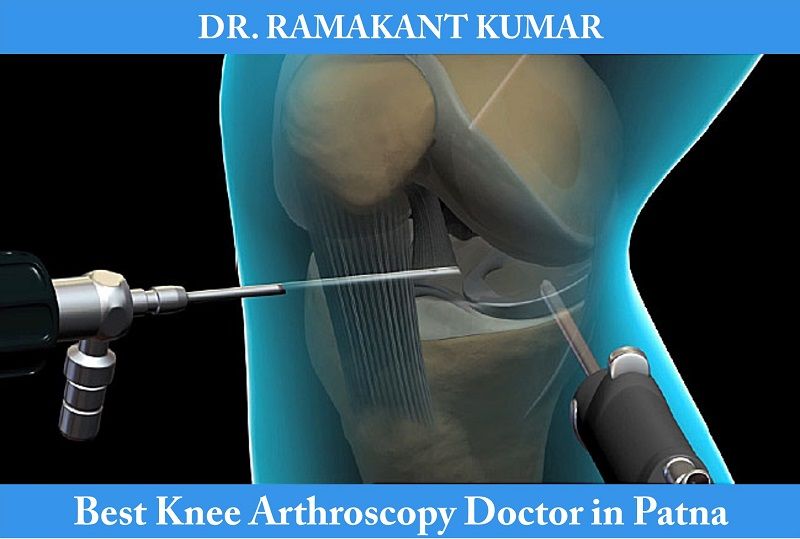 knee arthroscopy doctor in patna