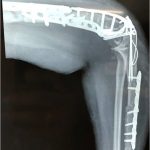Complex fracture