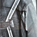 Complex fracture doctor patna