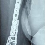 Complex fracture surgery patna