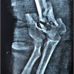 Complex fracture treatment patna