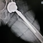 Hip Joint Replacement Doctor Patna