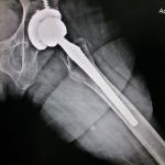 Hip Joint Replacement Doctor Patna