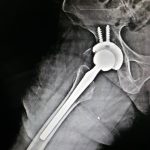 Hip Replacement Surgery Patna