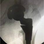 Hip replacement Surgery Bihar