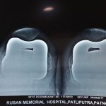 Knee Replacement Doctor Patna