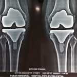 Knee Replacement Patna