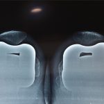 Knee Replacement Surgery Patna