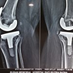 Knee Replacement Surgery Patna