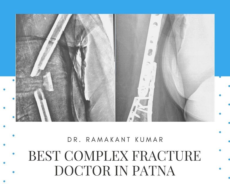 complex fracture doctor in patna