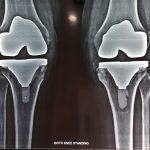 full knee replacement in patna