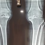 full knee replacement in patna