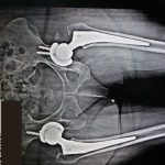 hip joint replacement Patna