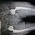 hip joint replacement Patna