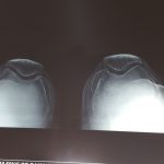 knee Replacement Patna