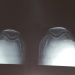 knee Replacement Patna
