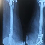 lower limp reconstruction patna