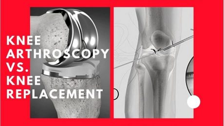 Difference between Knee Arthroscopy and Knee Replacement