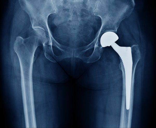 total hip replacement recovery