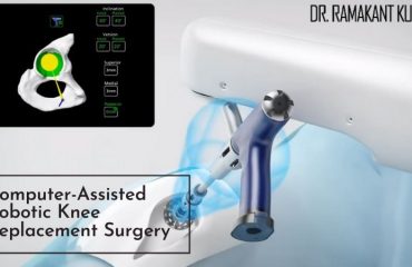 Computer-Assisted Robotic Knee Replacement Surgery