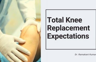 Total Knee Replacement Expectations