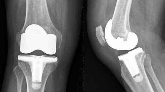 Joint Replacement - Arthroscopy