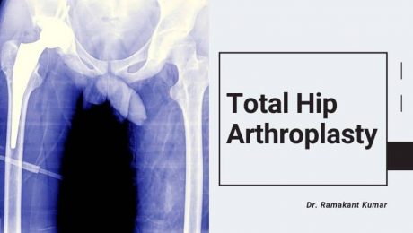 Total Hip Arthroplasty