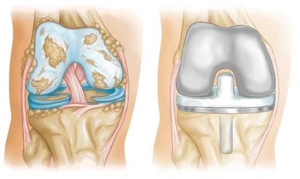 Arthroplasty Knee