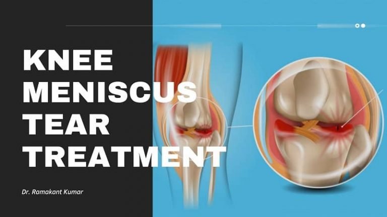 Knee Meniscus Tear Treatment [Torn Meniscus Symptoms & Recovery]