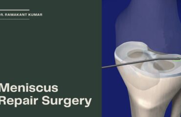 Meniscus Repair Surgery