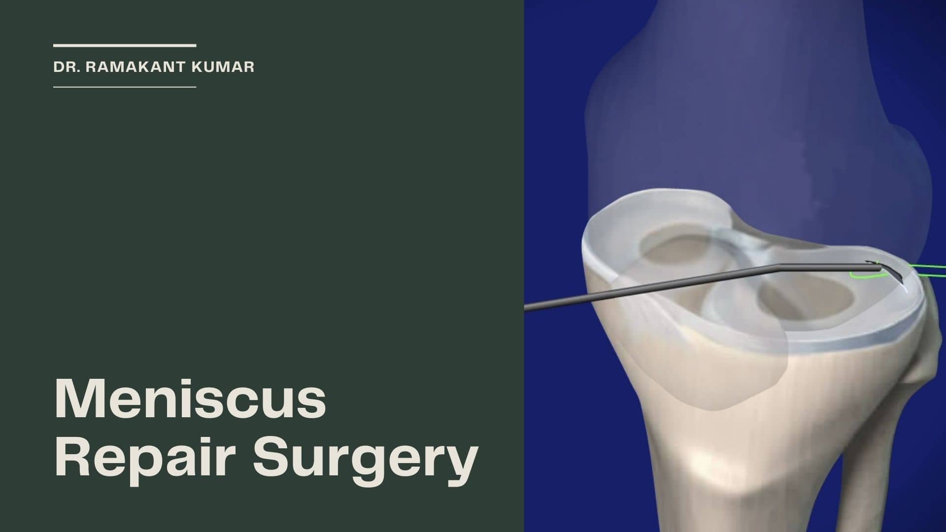 Meniscus Repair Surgery [Meniscectomy Vs. Meniscus Repair]