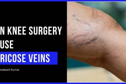 can knee surgery cause varicose veins
