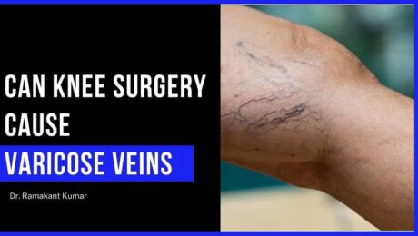 can knee surgery cause varicose veins