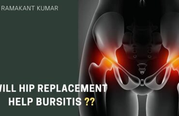 Will Hip Replacement Help Bursitis