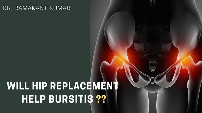 Will Hip Replacement Help Bursitis What Aggravates Hip Bursitis