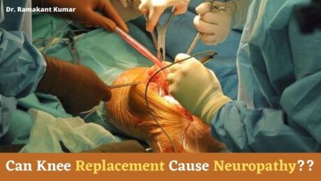 Can Knee Replacement Cause Neuropathy