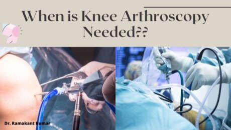 When is Knee Arthroscopy Needed