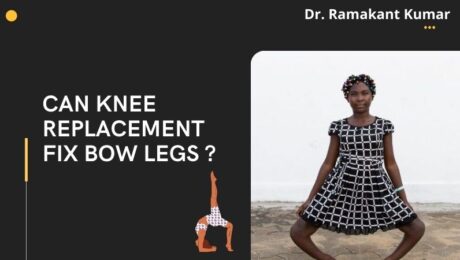 can knee replacement fix bow legs