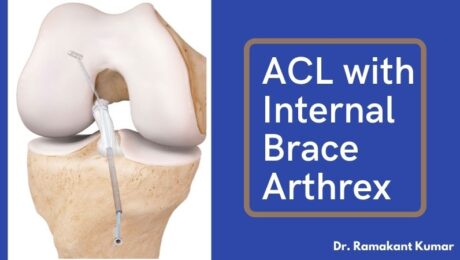 ACL with internal brace arthrex