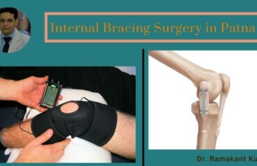 Internal Bracing Surgery in Patna