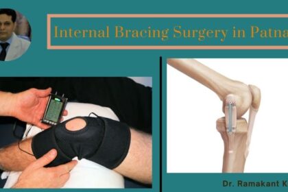 Internal Bracing Surgery in Patna