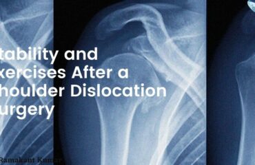 Stability and exercises after a shoulder dislocation Surgery