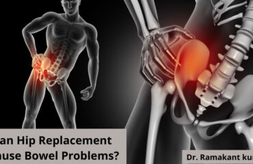 Can Hip Replacement Cause Bowel Problems