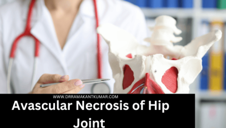 Avascular Necrosis of Hip Joint