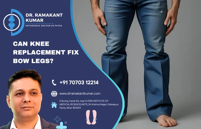 Can Knee Replacement Fix Bow Legs