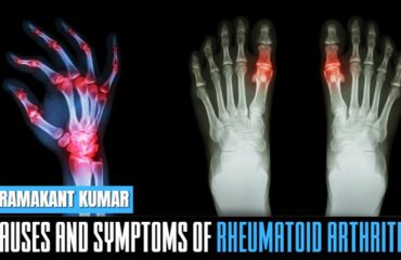 Causes and Symptoms of Rheumatoid Arthritis